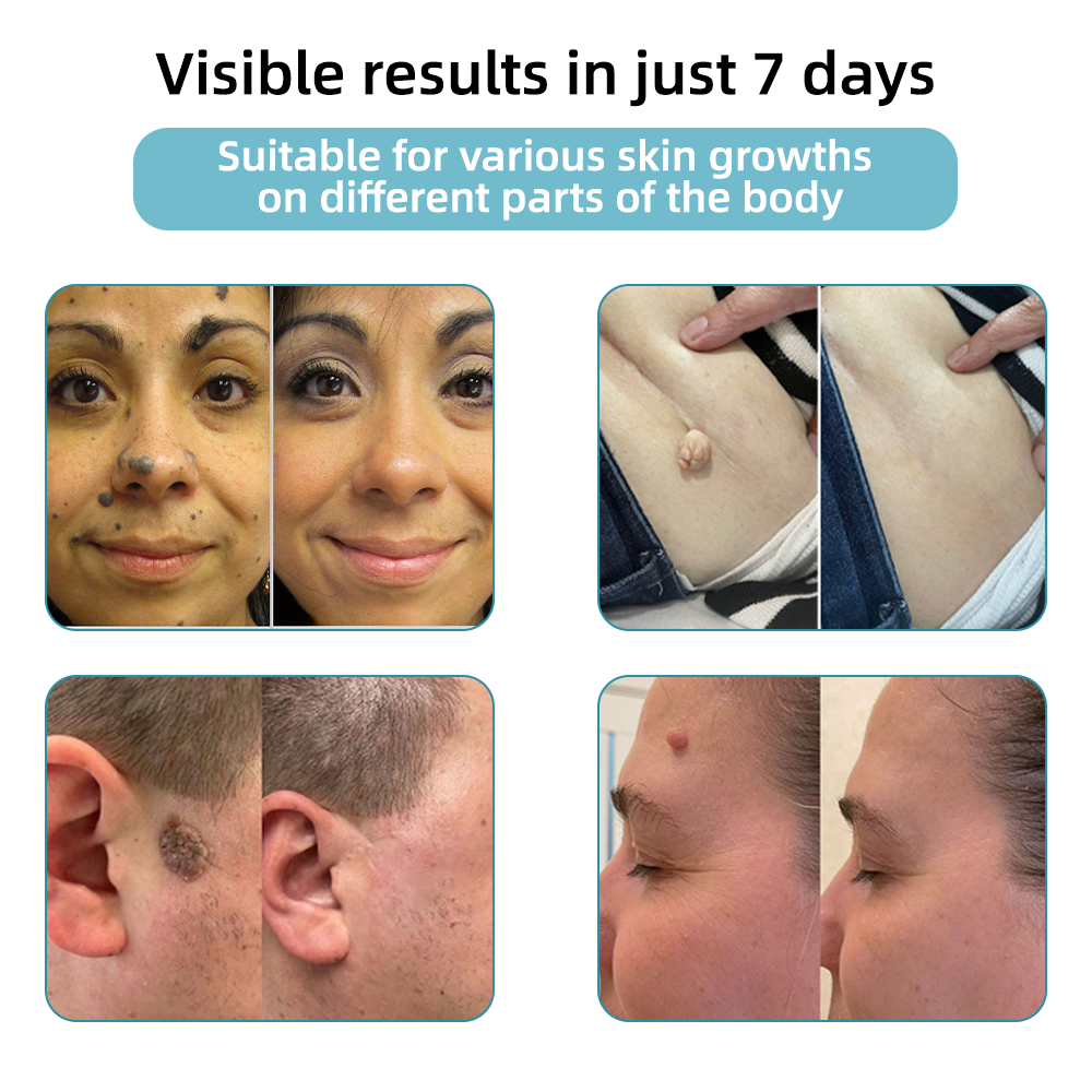 Vermoila® Non-Invasive Mole and Wart Removal Laser Pen Promax