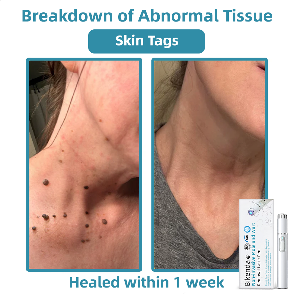 Vermoila® Non-Invasive Mole and Wart Removal Laser Pen Promax