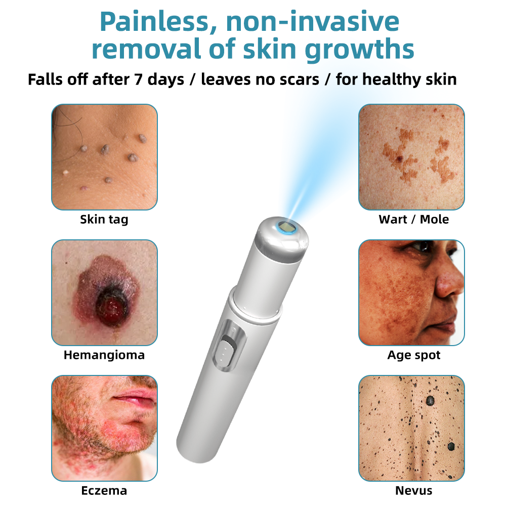 Vermoila® Non-Invasive Mole and Wart Removal Laser Pen Promax