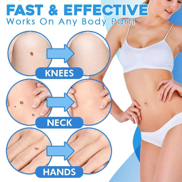 TagAway™ Advanced Skin Tag Removal Kit