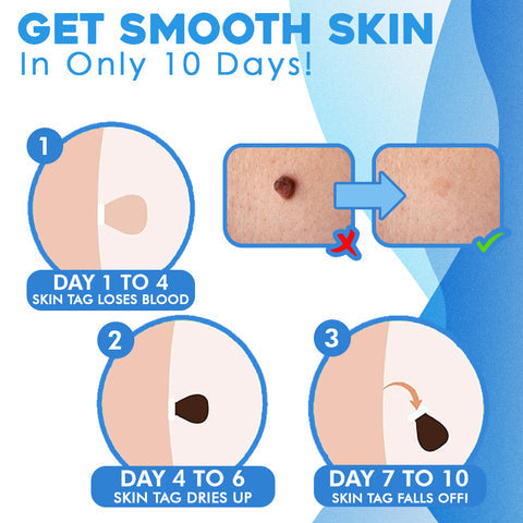 TagAway™ Advanced Skin Tag Removal Kit
