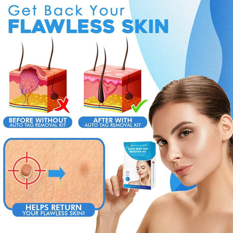 TagAway™ Advanced Skin Tag Removal Kit