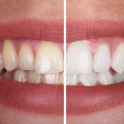 Whitening gel - For a radiant smile