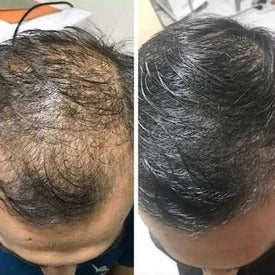 CapilLuxe™ | Reveal Your Gorgeous Hair: The #1 Regenerating Anti-Hair Loss Shampoo!