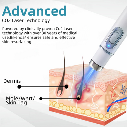 Vermoila® Non-Invasive Mole and Wart Removal Laser Pen Promax