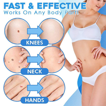TagAway™ Advanced Skin Tag Removal Kit